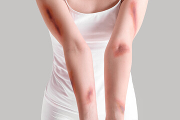 Young woman with bruised arms on grey background, closeup