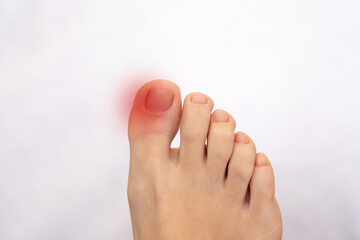 Inflammation on female foot with red spot. Concept of feet pain and disease