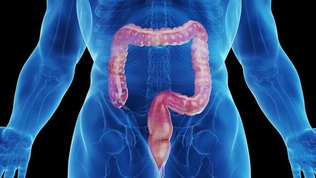 Divertikel Bilder Durchsuchen 291 Archivfotos, und