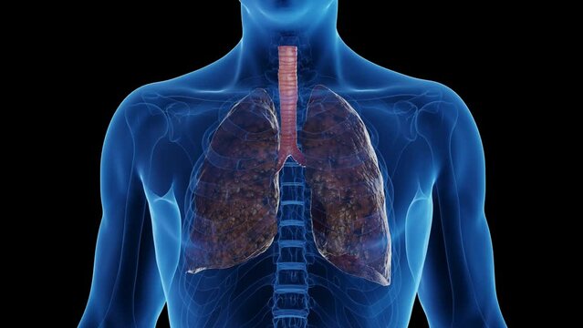 3d rendered medical animation of a smoker's lungs