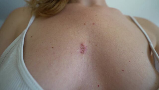 A wound that heals and turns into a scar after removing a cyst on a woman's breast.
A wound on chest. crusty scab.