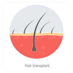 Hair transplant