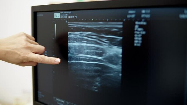 doctor pointing out at a problematic area in a live sonogram on a monitor using an ultrasonography diagnostic machine in a physiotherapy clinic