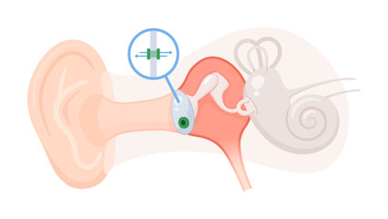 鼓膜チューブを挿入した耳と鼓膜の断面のイラスト_中耳炎