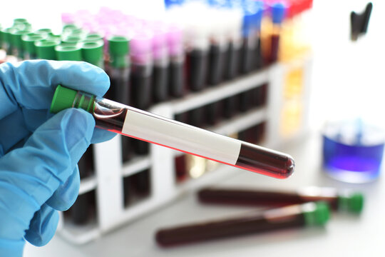 Medical worker lab technician holding vial of blood for testing, blank label mock up text overlay 