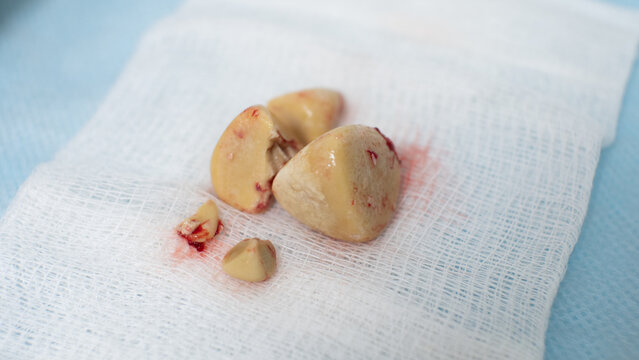 On a white napkin are stones from the bladder removed by the operation of cystolithotomy. The formation of stones in the bladder is called urolithiasis.