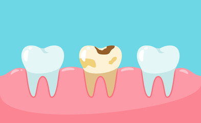 Vector unhealthy teeth. Cavities and dental plaque