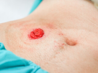 Belly of a young Caucasian male patient in a turquoise disposable medical pajamas with a protruding intestine