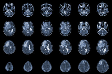 MRI Brain Axial views .to evaluate brain tumor. Glioblastoma, brain metastasis isodensity mass with an ill-defined margin and surrounding edema at the right frontal lobe.