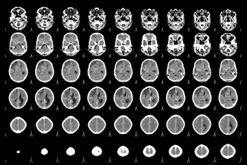 CT Scan Brain Axial views .to evaluate brain tumor. Glioblastoma, brain metastasis isodensity mass with an ill-defined margin and surrounding edema at the right frontal lobe.