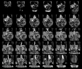 Magnetic resonance imaging (MRI)OF UPPER ABDOMEN of a patient who has suspected mass-forming hilar...