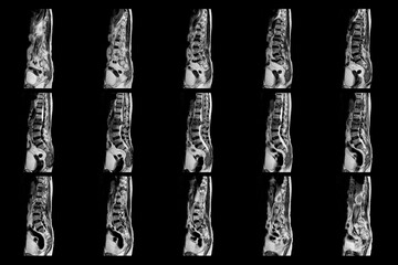 MRI OF THE THORACOLUMBAR SPINE a patient who has moderate to severe compression fractures of T11...