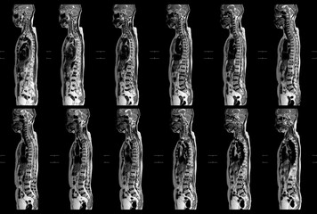 MRI OF THE THORACOLUMBAR SPINE a patient who has moderate to severe compression fractures of T11...