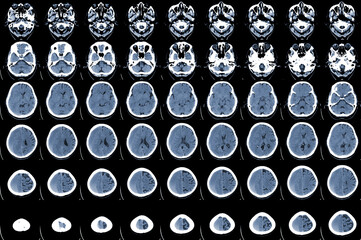 CT Scan brain acute on top subacute subdural hematoma (SDH) along left cerebral...