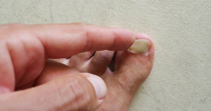 Toenail peel away with parts splitting or broken off. Cracked nail after hit.