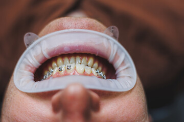 Obraz premium Dental treatment of teeth. A young man at a dentist's appointment. The doctor installs metal braces on the teeth. Close-up of teeth with braces