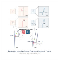 It is worth noting that many electrocardiographic textbooks believe that hyperacute T waves are symmetrical. In fact, they are not symmetrical.