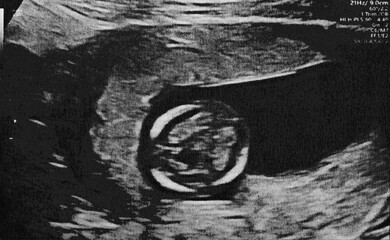 Fototapeta premium Pregnant baby infant ultrasound display. Mother belly screen in hospital. Womb scan