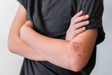 skin of the hands with red wounds of diathesis and dermatitis from allergies and stress close-up