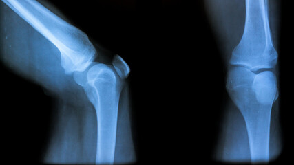 x ray image of knee