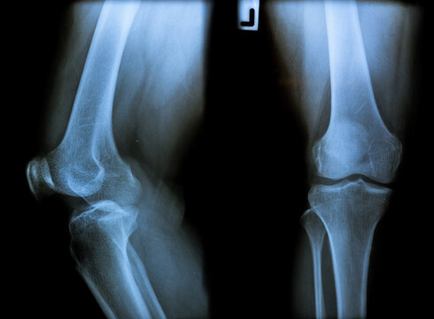 x ray image of knee