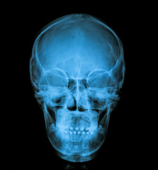 Fototapeta premium x ray image of skull