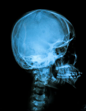 x ray image of human skull