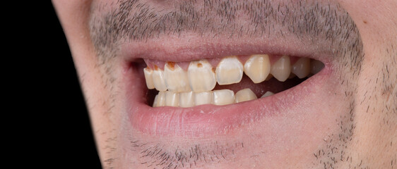 Obraz premium dental photography picture of dental treatment case