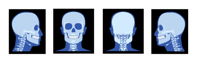 Set of X-Ray Head and neck Skeleton Human body Bone adult people roentgen front back side view. 3D realistic flat blue color concept Vector illustration of medical anatomy isolated on black background