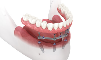Mandibular prosthesis with gum All on 4 system supported by implants. Medically accurate 3D illustration