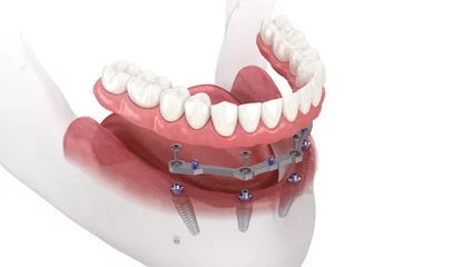 Fotobehang Mandibular prosthesis with gum All on 4 system supported by implants. Medically accurate 3D illustration © Alex Mit