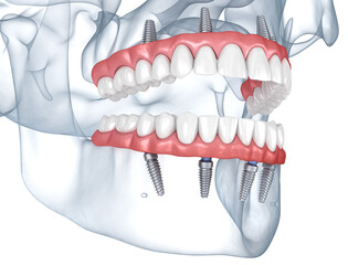 Prostheses supported by 8 implants. Dental 3D illustration