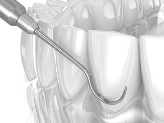 Scaling and root planing (periodontal therapy). Medically 3D illustration