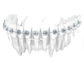 Dental braces and teeth. 3D illustration