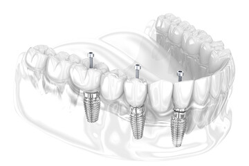 Dental bridge based on 3 implants. Dental 3D illustration