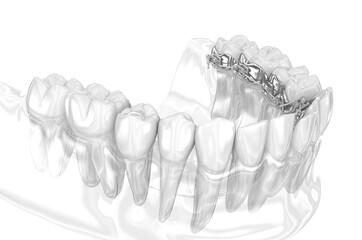 Lingual braces system. 3D illustration concept of golden braces
