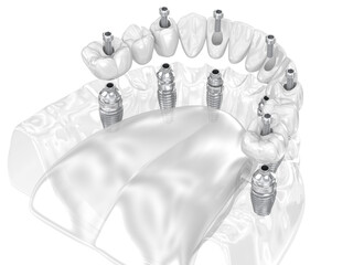 Dental prosthesis supported by six implants. Dental 3D illustration