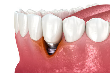 Peri-implantitis with visible gingiva recession. Medically accurate 3D illustration. - 551471382