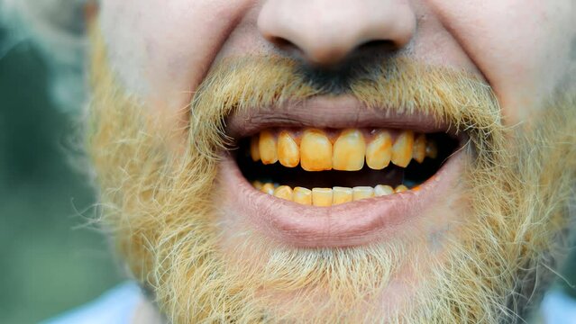 Male mouth with yellow dirty teeth. The mouth of a homeless man with a yellow beard and teeth