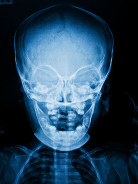 x ray image of a human skull
