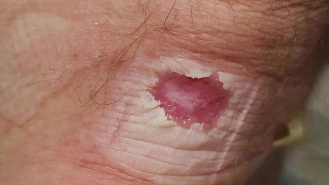 A man removes a band-aid from a callus blister on his Achilles heel