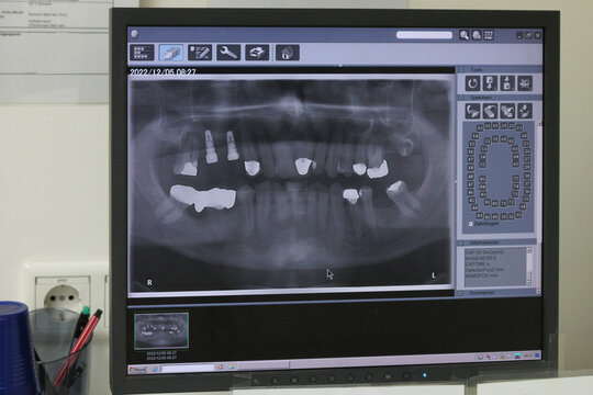 Implants and fillings are visible on the jaw X-ray
