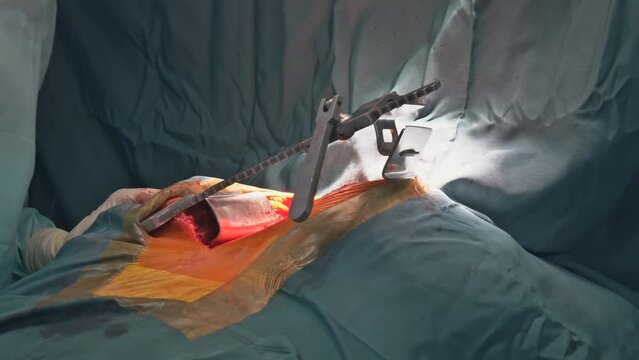 Open heart surgery due to malfunction of the heart valve, valve replacement is performed in the hospital operation room