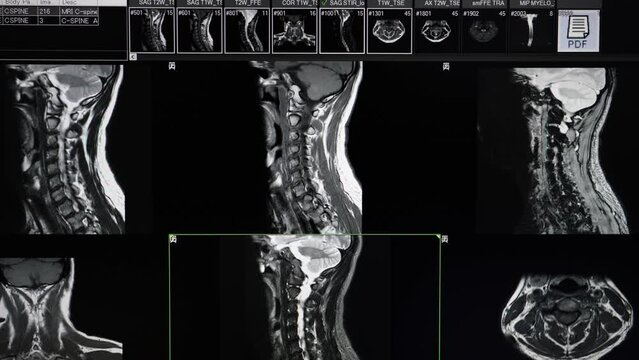 Cervical spine MRI scan of a patient with neck and shoulder pain showing disc bulging and spinal canal stenosis without cord compression.