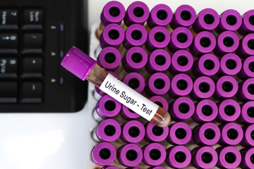 Urine Sugar test to look for abnormalities from Urine,  Urine sample to analyze in the laboratory