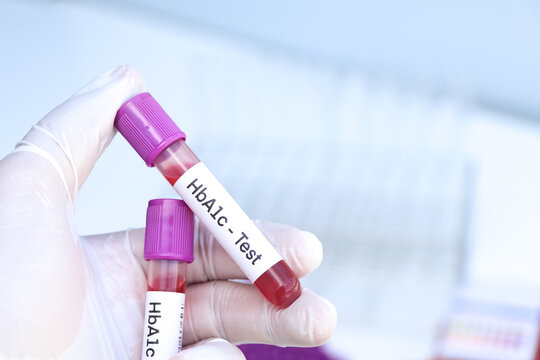 HbA1c test from blood , Blood samples to be analyzed in the laboratory