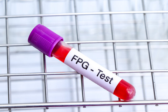 FPG-test from blood , Blood samples to be analyzed in the laboratory