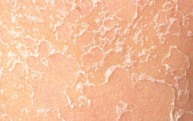 Sunburn, close-up of human skin. Flaky skin from allergies, peeling or eczema. Dry skin in need of treatment and hydration.