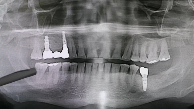 Dental jaw X-ray with teeth and implants. Missing teeth. Dentist uses pen to point at area on image. X-ray radiography. Dentist examines dental arch on computer screen. 4 k video