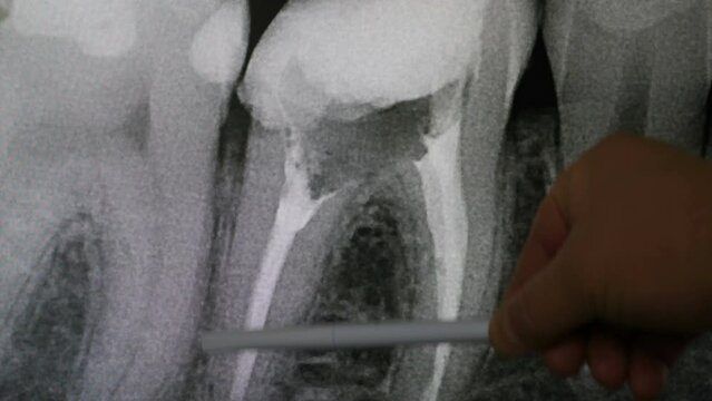 Black and white roentgen of teeth. Dental jaw X-ray. Bad teeth. Dentist uses pen to point at area on image. X-ray radiography. Dentist examines dental arch on computer screen. 4 k video